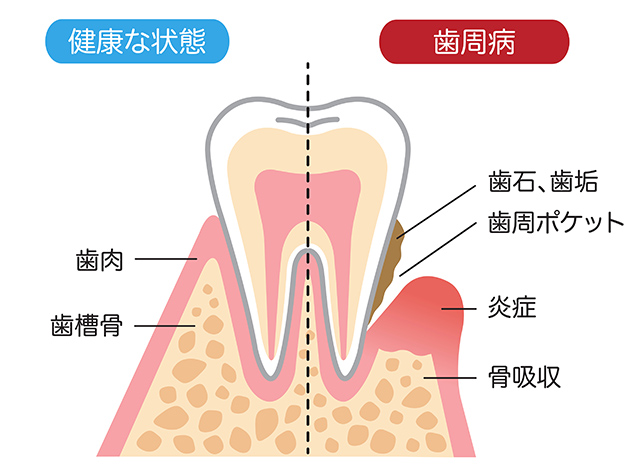 歯周病の歯について
