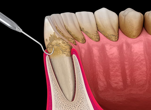 歯周病の原因「プラーク」